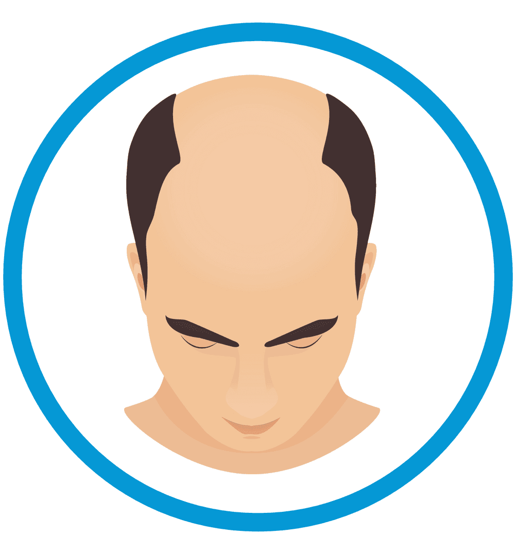 anti-haarverlust shampoo gegen anzeichen haarausfall bei mann glatze und geheimratsecken