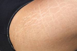 cellulite-leggings-noppen