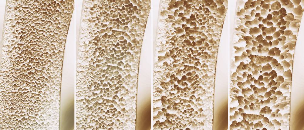 cissus quadrangularis osteoporose
