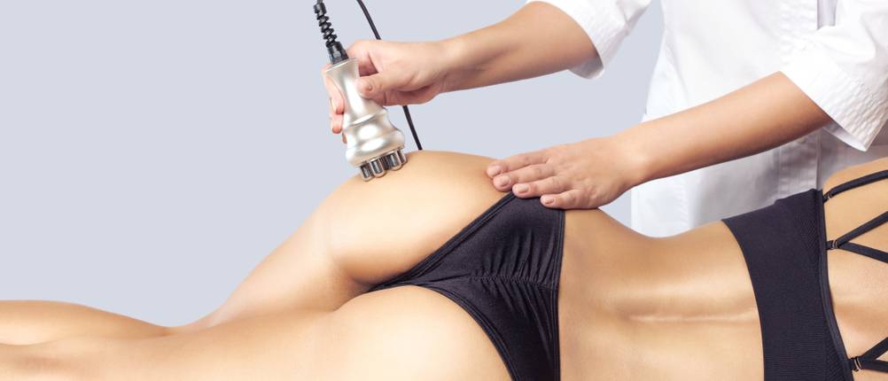 Dehnungsstreifen-Creme Alternative Laser