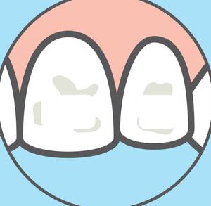 weiße Flecken auf Zähnen