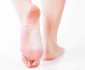 Häufig tritt Fußpilz an der Fußsohle oder zwischen den Zehen auf.