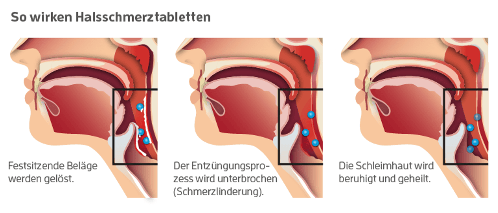 halsschmerztabletten