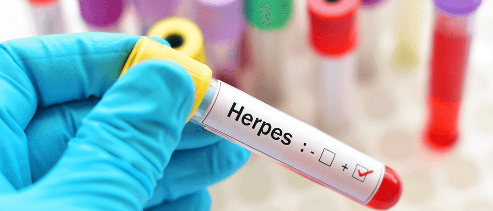 herpes creme test