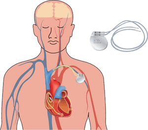 defibrillator implantiert