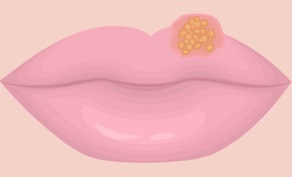 herpes creme herpes salbe herpes gel virostatikum
