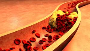 Clogged Artery with platelets and cholesterol plaque, concept for health risk for obesity or dieting and nutrition problems