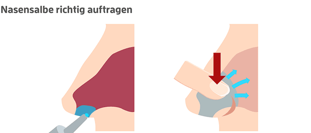 nasensalbe auftragen