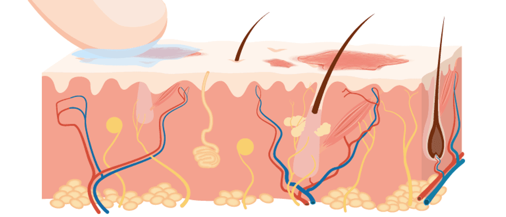 neurodermitis creme haut