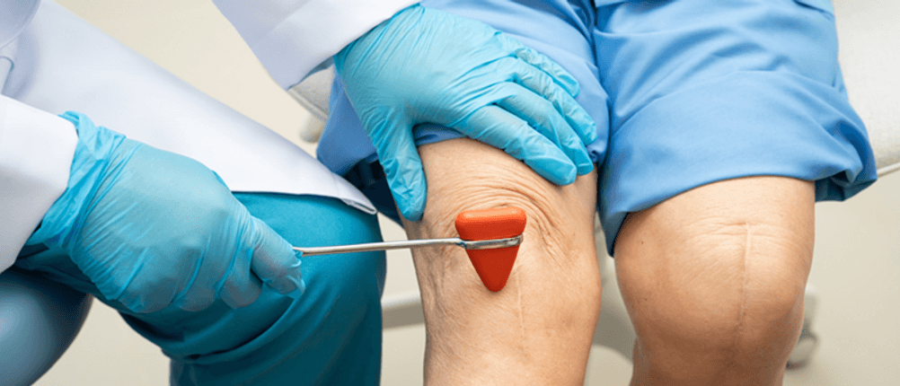 Reflexhammer getestet: Arzt schlägt mit einem Reflexhammer auf das Knie.