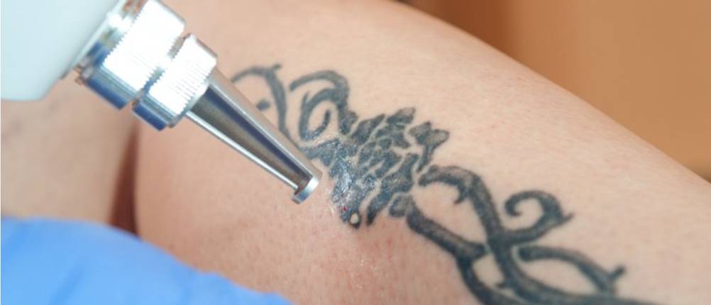 tattoo entfernen creme