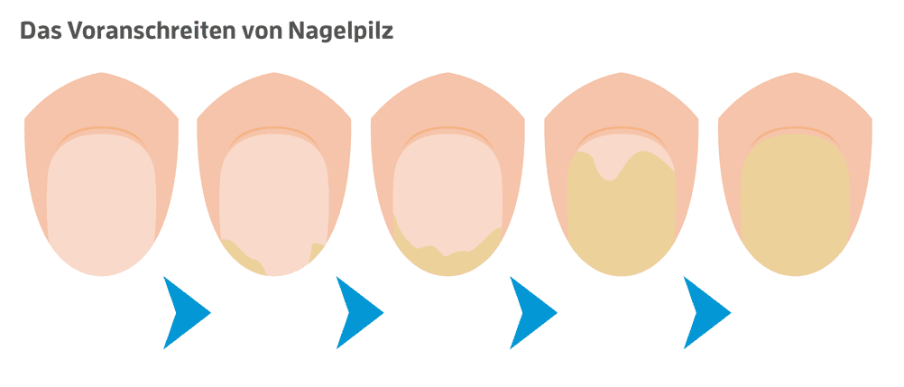 nagelpilz befall voranschreiten