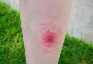zecken-spray-borreliose-infektion