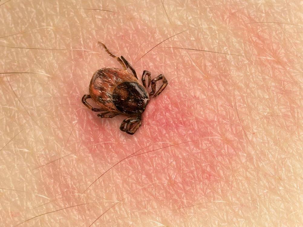 zecken-spray-infektion-durch-zeckenbiss