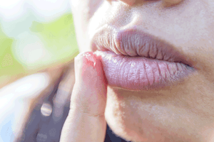 zinksalbe herpes