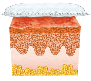 Zinksalbe Windeldermatitis