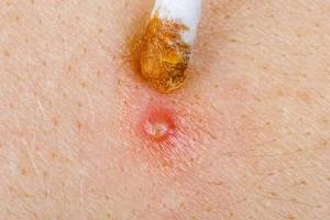 akne, die mithilfe von propolis-salbe behandelt wird